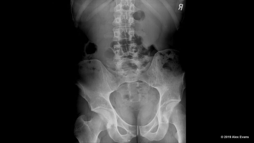 Leg Length Discrepancy X-Ray