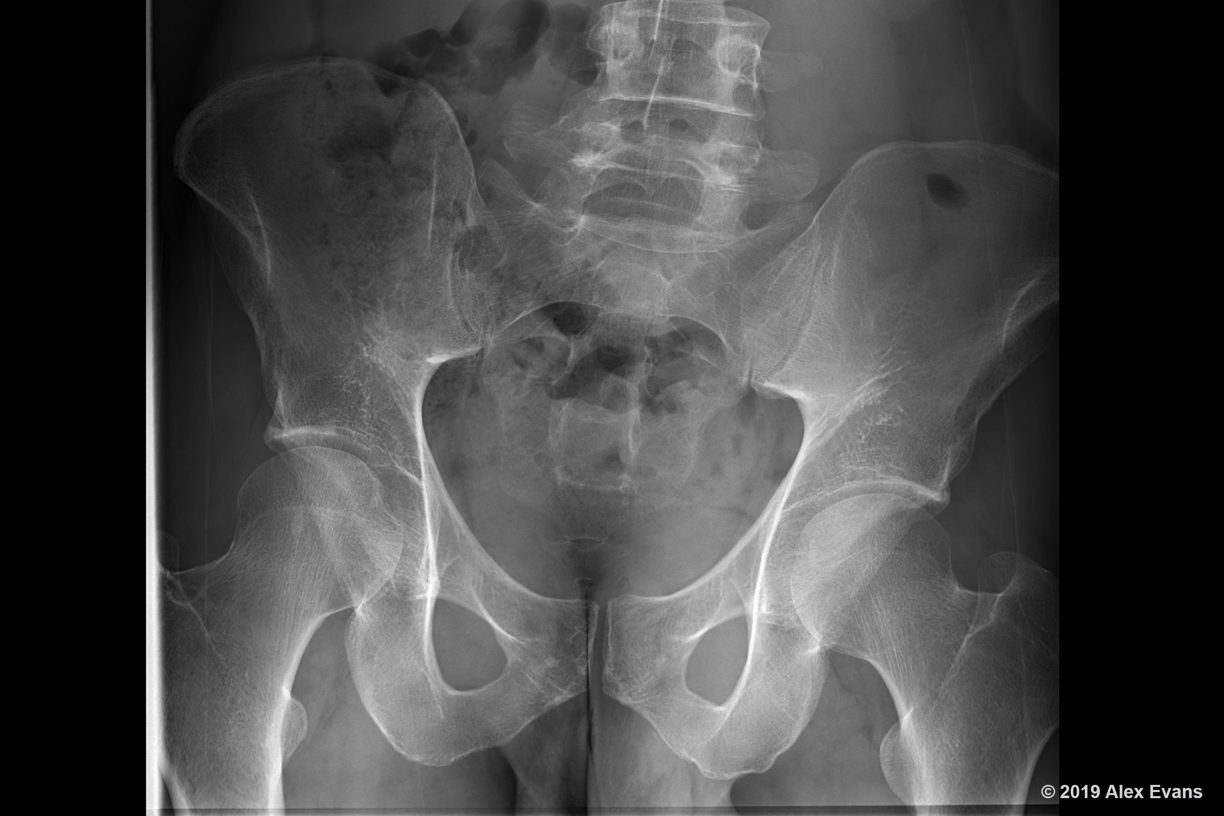 Leg Length Discrepancy X-Ray